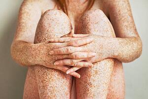 Fotografi Freckled girls hands, arms and legs, close up, Dimitri Otis, (40 x 26.7 cm)